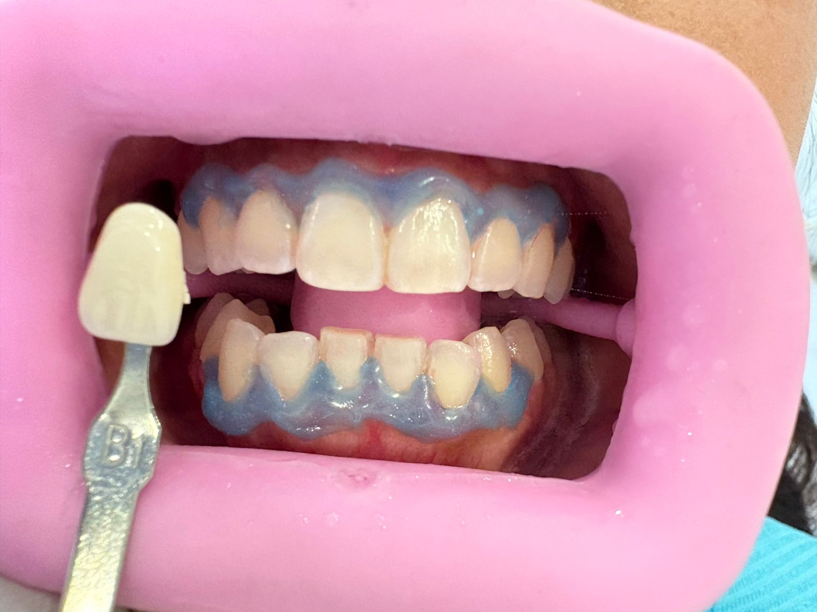After Bleaching